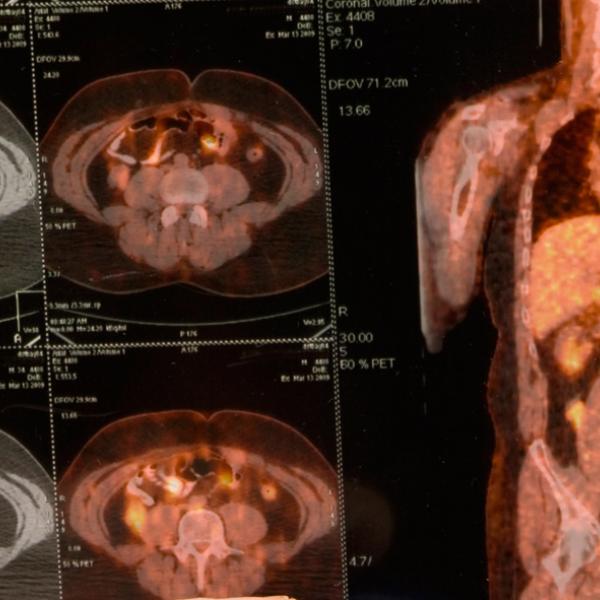 Cyclotrons and PET scans fact sheet