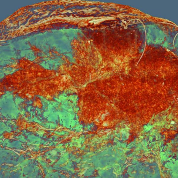 Breast imaging using Phase contrast tomography