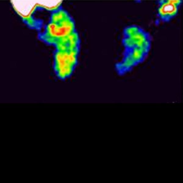 Neuroblastoma research