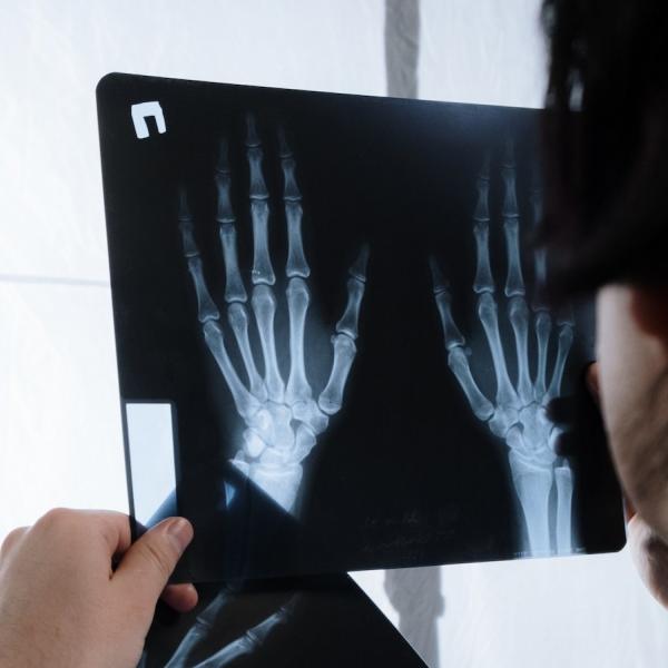 Osteoporosis