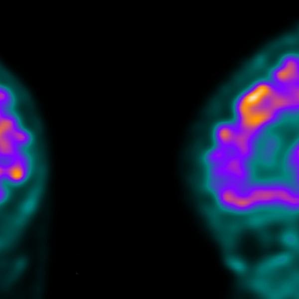 PET SCAN
