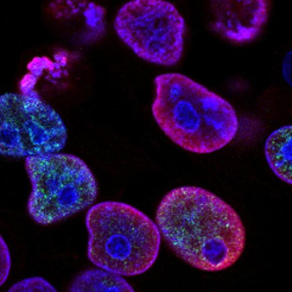 cancer cells