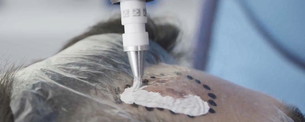 Non-invasive skin cancer treatment manufactured by ANSTO in Southern Sydney