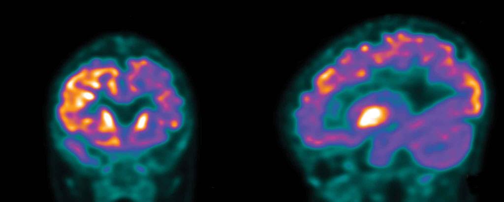 Brain scan