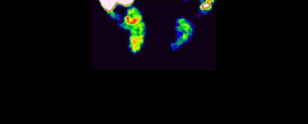 Neuroblastoma research