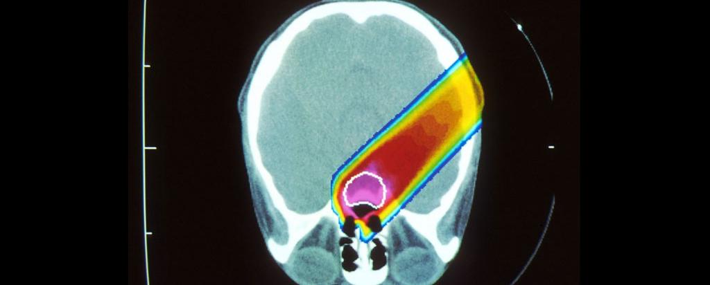 Proton beam therapy