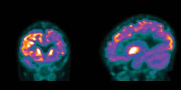 PET scan