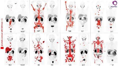 PET scans Lu 177 clinical trial