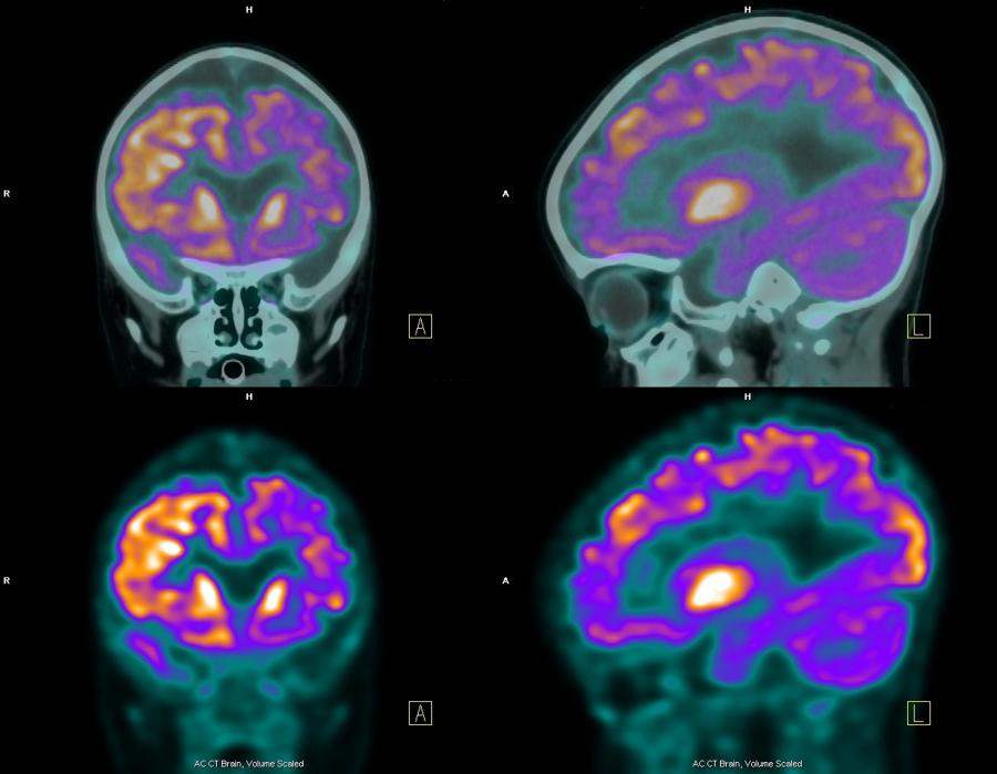 Nuclear medicine scans