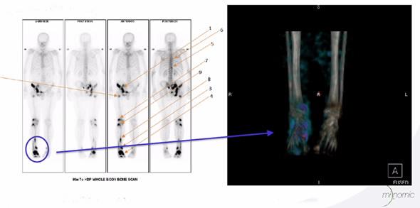 MILGAa cancer diagnostic