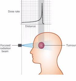 Carbon ion therapy diagram